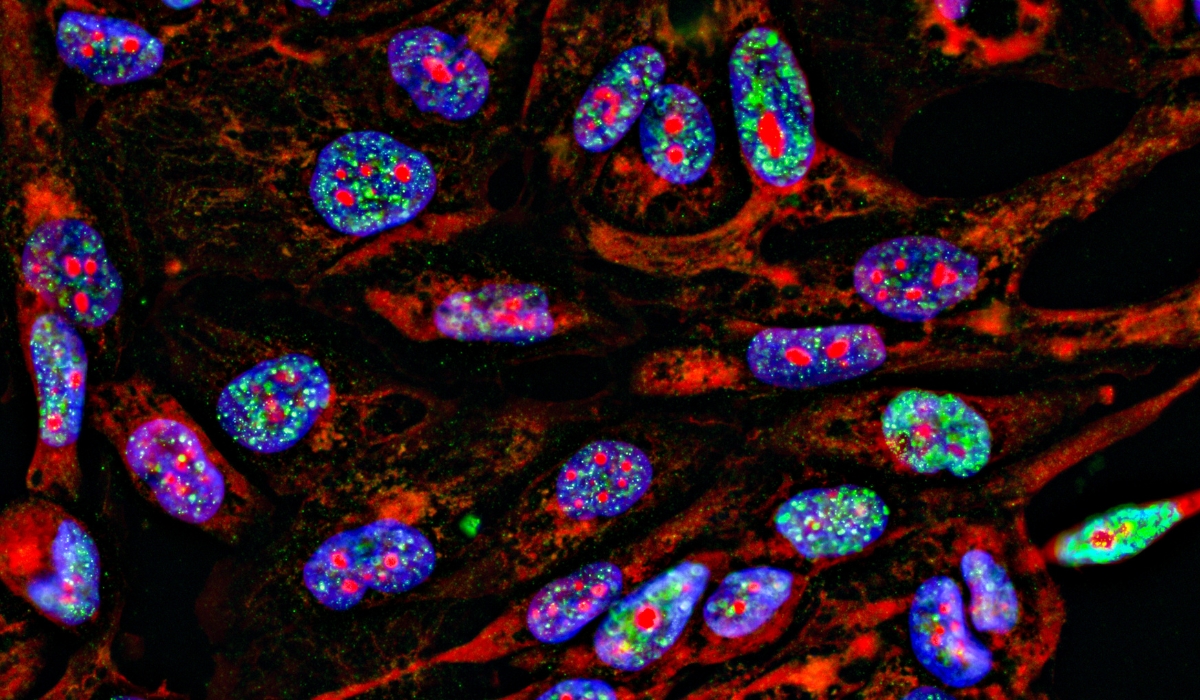 Cancer cells being detected