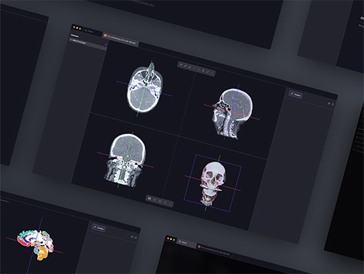 App screens showing neurosurgical planning prototype