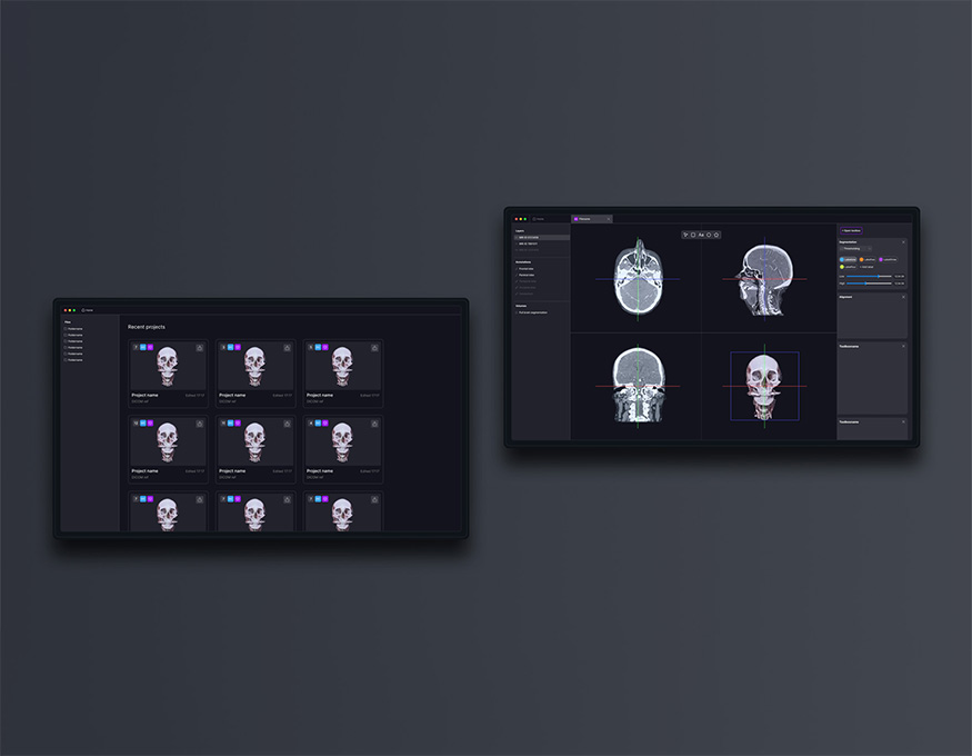 App screens showing neurosurgical planning prototype mobile