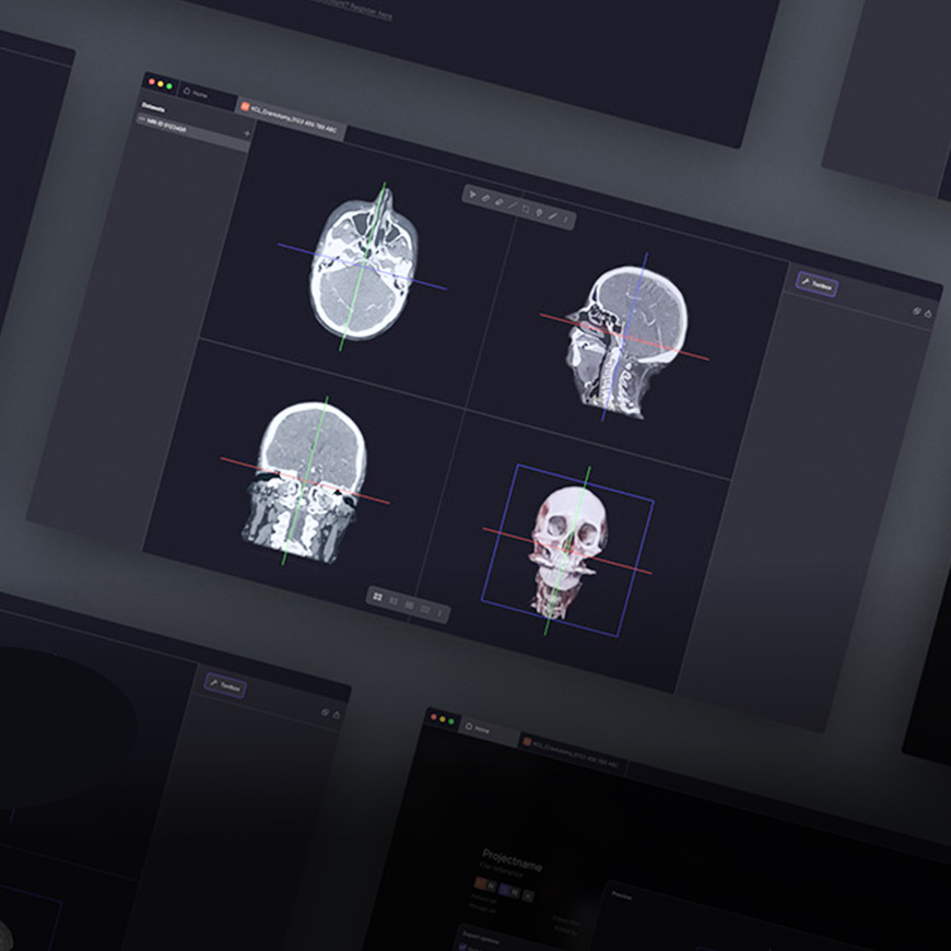 App screens showing neurosurgical planning prototype