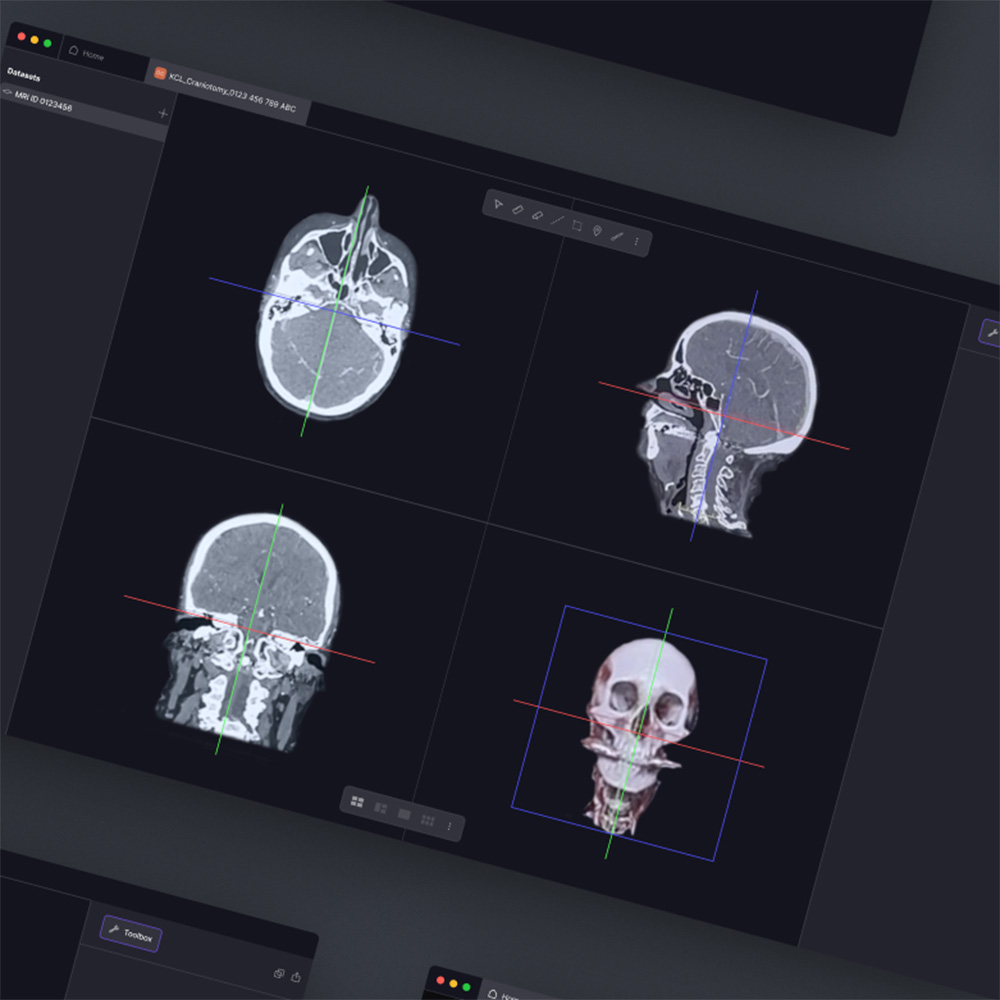 App screens showing neurosurgical planning prototype