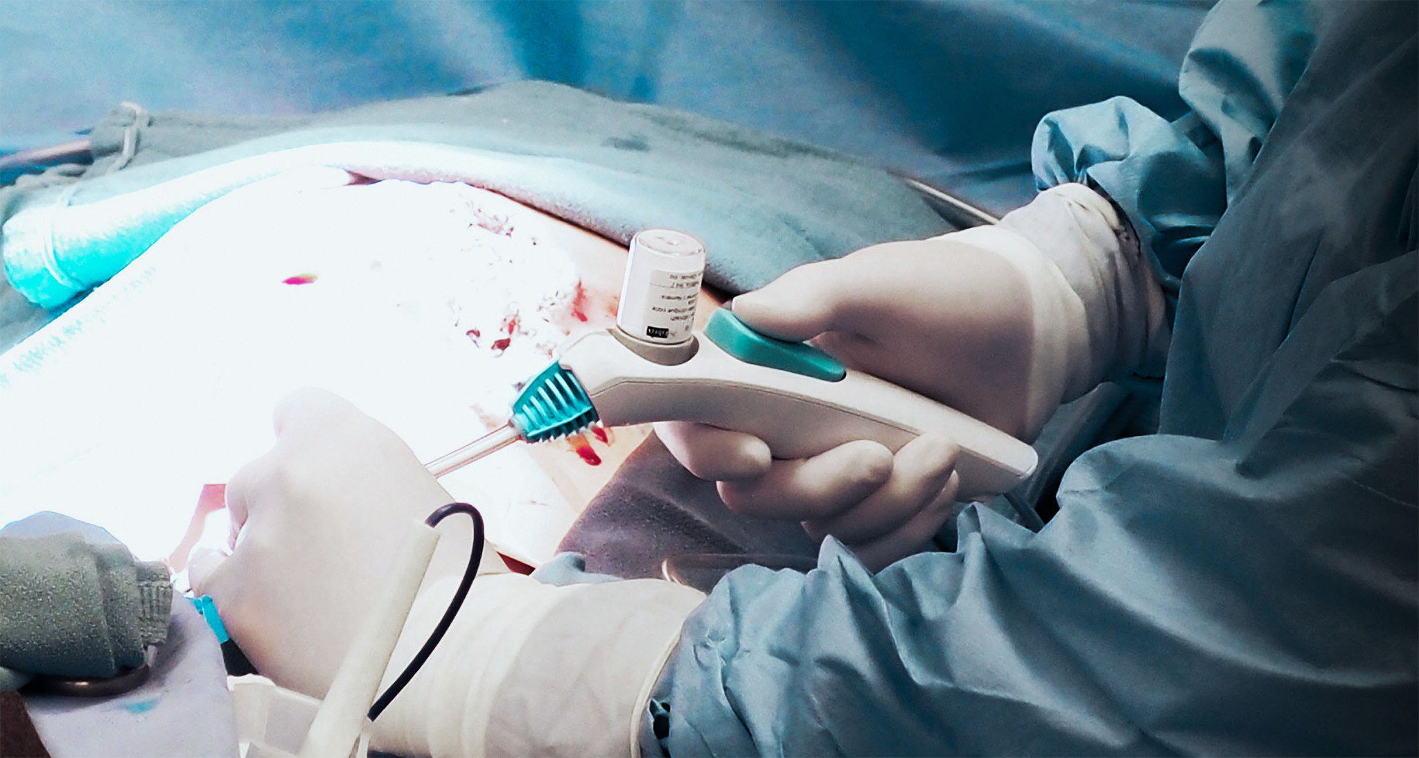 Surgical Bleeding Control Device Development | Team Consulting
